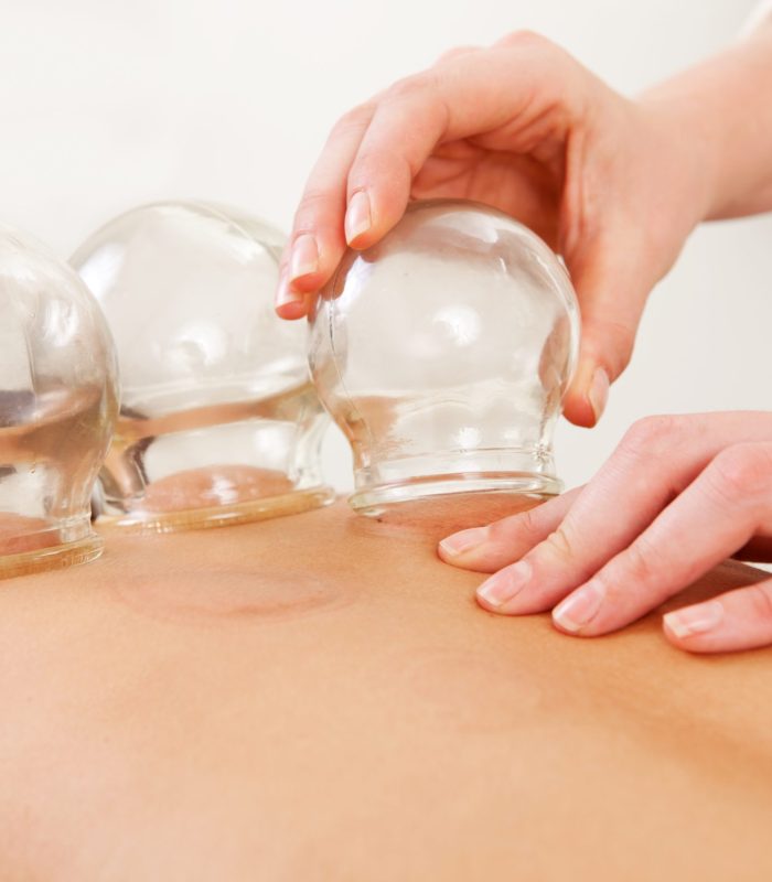 Detail,Of,An,Acupuncture,Therapist,Removing,A,Glass,Globe,In